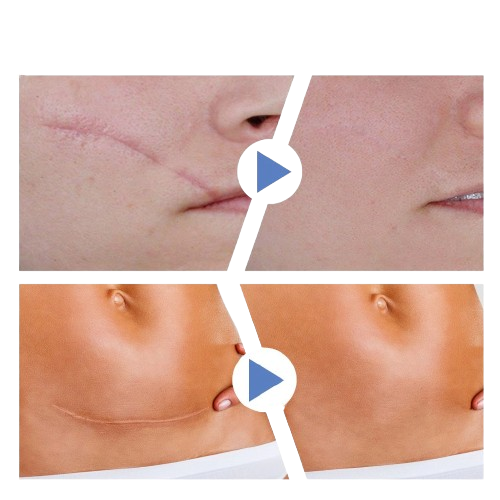 Piel Perfecta en 4 Semanas - Cinta Cicatrizante Silicona Médica